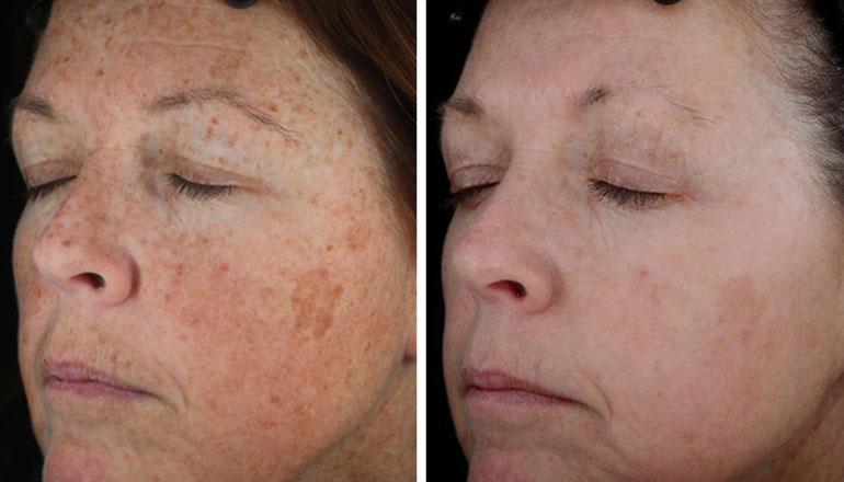 Before and After 6 IPL Treatments